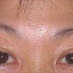 Eye Lift Before & After Patient #233