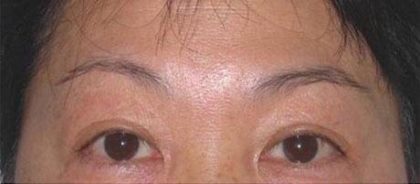 Eye Lift Before & After Patient #233