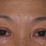 Eye Lift Before & After Patient #233