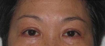 Eye Lift Before & After Patient #233