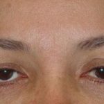 Eye Lift Before & After Patient #236