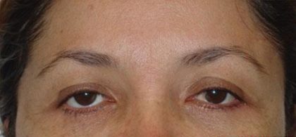 Eye Lift Before & After Patient #236