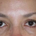 Eye Lift Before & After Patient #236