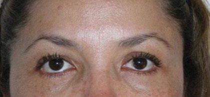 Eye Lift Before & After Patient #236