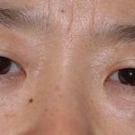 Eye Lift Before & After Patient #237