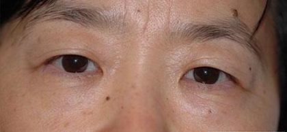 Eye Lift Before & After Patient #237