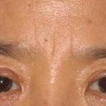 Eye Lift Before & After Patient #237