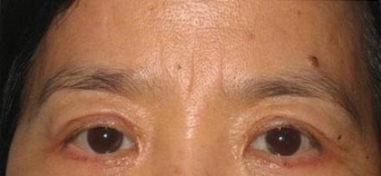 Eye Lift Before & After Patient #237