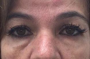 Facial Fillers Before & After Patient #173