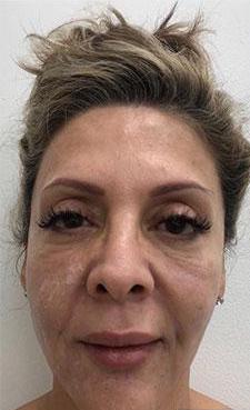 Facial Fillers Before & After Patient #177