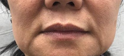 Facial Fillers Before & After Patient #176