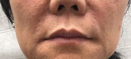 Facial Fillers Before & After Patient #176