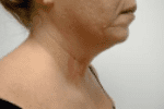 Non-Surgical Face & Neck Lift Before & After Patient #183