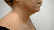 Non-Surgical Face & Neck Lift Before & After Patient #183