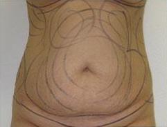 Liposculpture Before & After Patient #305