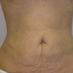 Liposculpture Before & After Patient #305