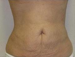 Liposculpture Before & After Patient #305