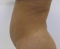 Liposculpture Before & After Patient #309