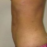 Liposculpture Before & After Patient #309