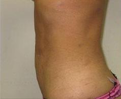 Liposculpture Before & After Patient #309