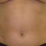 Liposculpture Before & After Patient #310