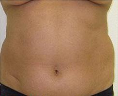 Liposculpture Before & After Patient #310