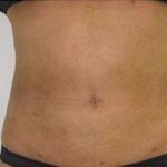 Liposculpture Before & After Patient #310