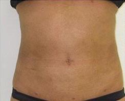 Liposculpture Before & After Patient #310