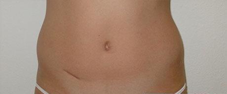 Liposculpture Before & After Patient #313