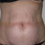 Liposculpture Before & After Patient #314