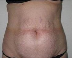 Liposculpture Before & After Patient #314