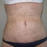 Liposculpture Before & After Patient #314