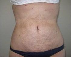 Liposculpture Before & After Patient #314