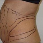 Liposculpture Before & After Patient #315