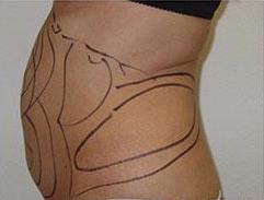 Liposculpture Before & After Patient #315