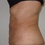 Liposculpture Before & After Patient #315