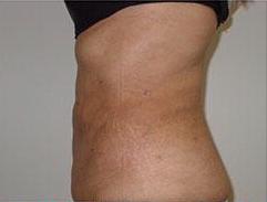 Liposculpture Before & After Patient #315