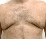 Male Breast Reduction Before & After Patient #203