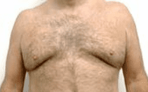 Male Breast Reduction Before & After Patient #203