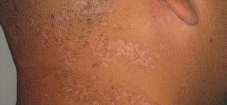 Mole Removal Before & After Patient #111