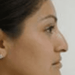 Rhinoplasty Before & After Patient #206