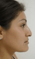 Rhinoplasty Before & After Patient #206