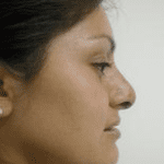 Rhinoplasty Before & After Patient #206