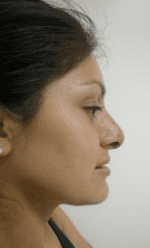 Rhinoplasty Before & After Patient #206