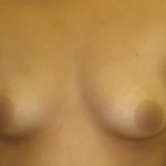 Breast Augmentation Before & After Patient #912