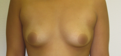 Breast Augmentation Before & After Patient #912