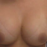 Breast Augmentation Before & After Patient #912