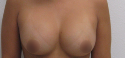 Breast Augmentation Before & After Patient #912