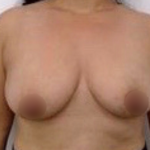 Breast Augmentation Before & After Patient #915