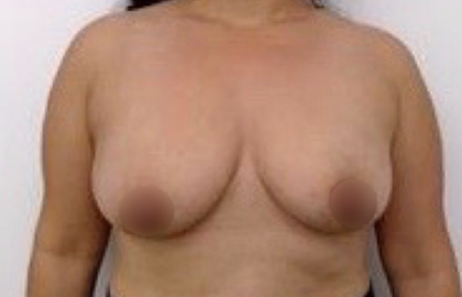 Breast Augmentation Before & After Patient #915